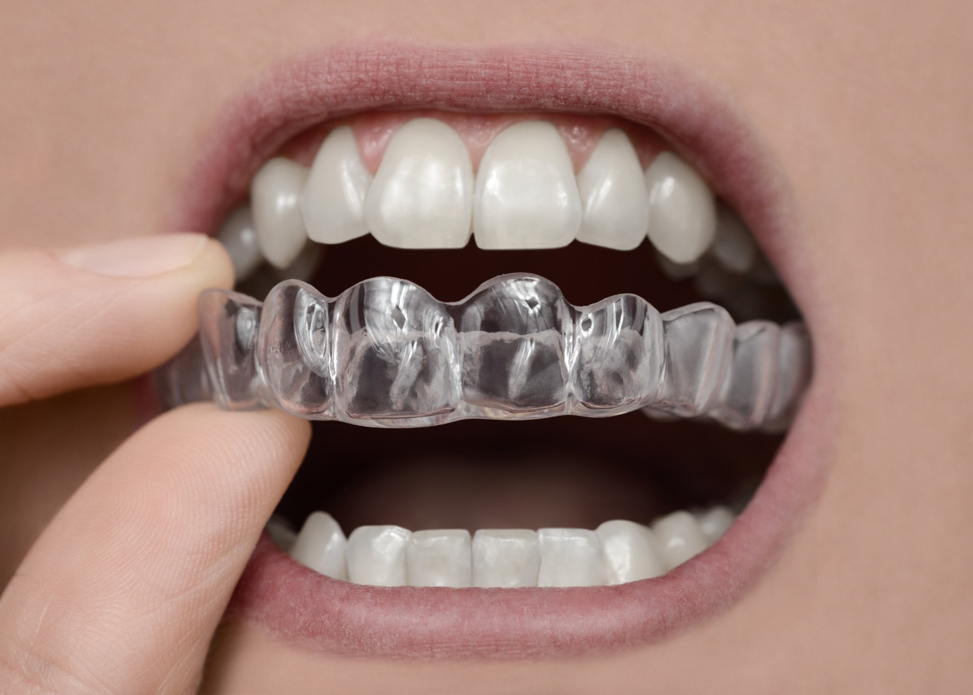 Replacement Retainers Signs You Need a New One